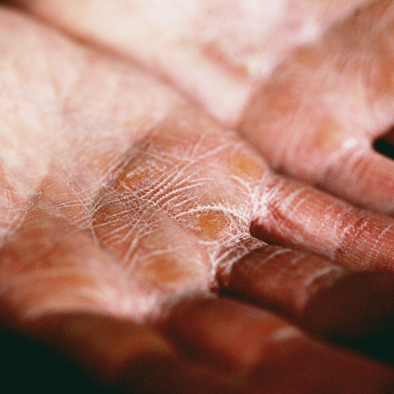 Dry skin on hands